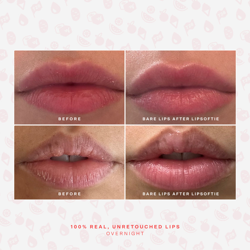 SOS LipSoftie® Lip Treatment